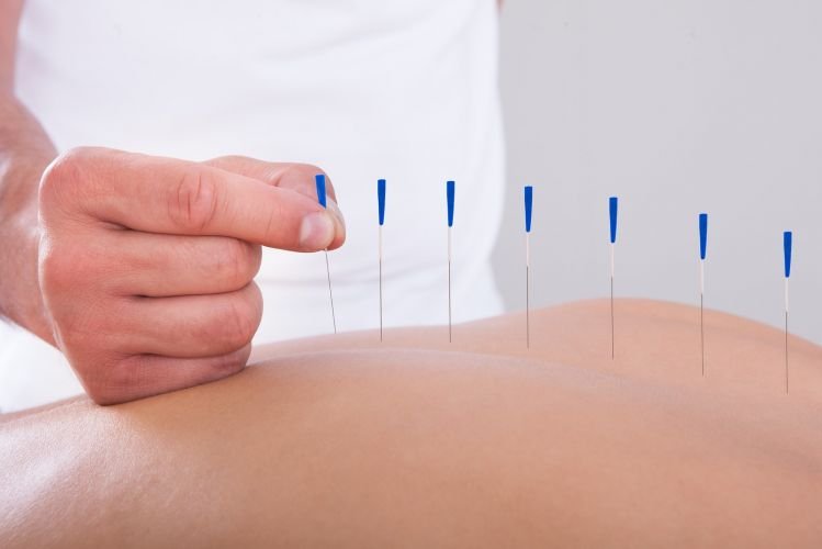 Acupuncture needles on a person's back